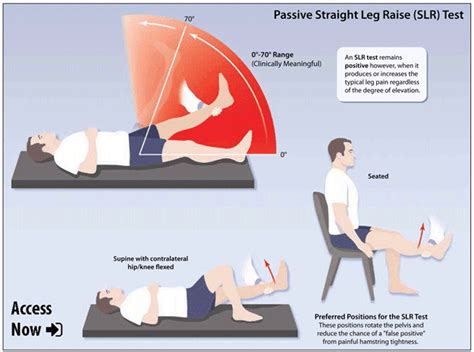 slr test for sciatic nerve